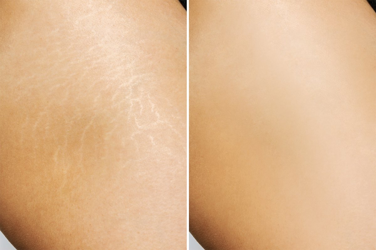 Stretch Marks